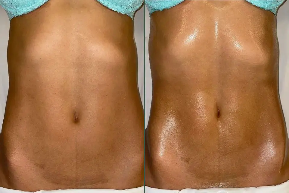 Vorher Nachher Ergebnis einer brasilianischen Lymphdrainage in München mit glatterem und sichtbar gestrafftem Bauch